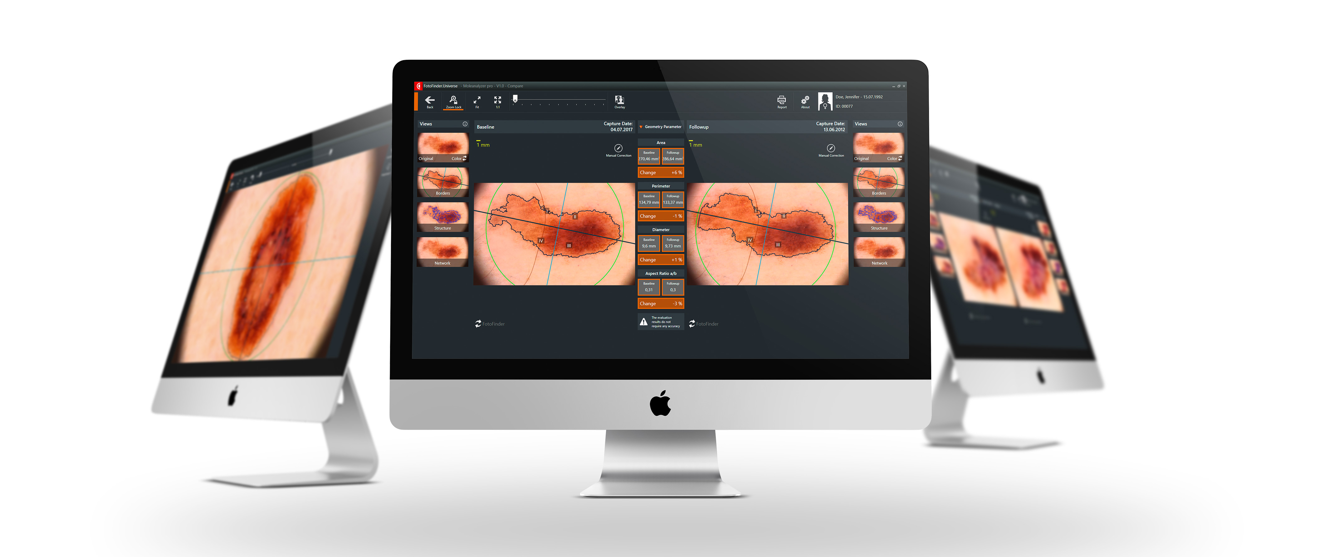 FotoFinder Moleanalyzer pro